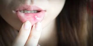 防范口腔溃疡需保持健康的生活习惯